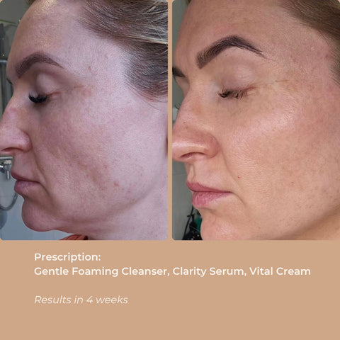 Visible before and after images showing skin clarity improvement from Clarity Serum