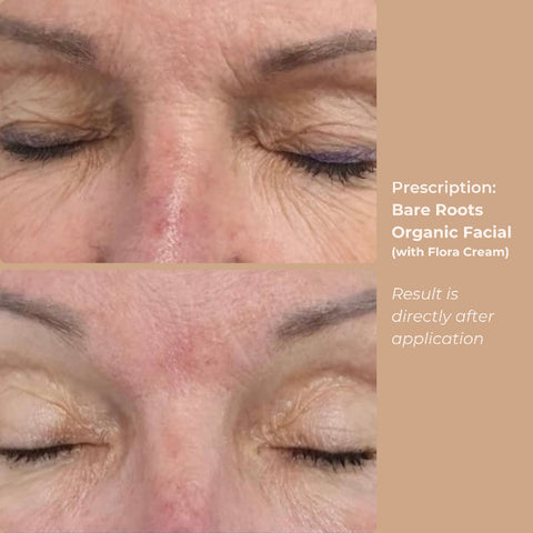 Before and after photos showing skin improvement after using Flora Cream