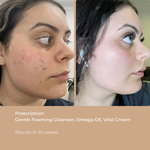 Before and after photos showing improved skin clarity and hydration after using the Gentle Foaming Cleanser.
