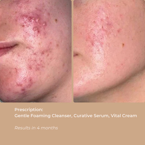 Side-by-side before and after photos showing skin improvement after using Vital Cream.