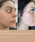 Before and after photos showing improved skin clarity and hydration after using the Gentle Foaming Cleanser.