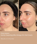 Before and after images showing skin improvement after using Gentle Cleansing Milk.