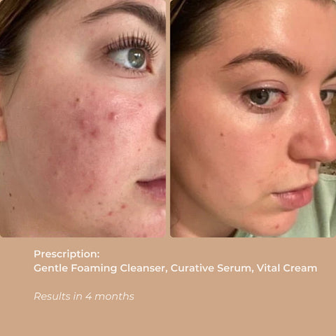 Before and after photos showing skin improvements after using Curative Serum.