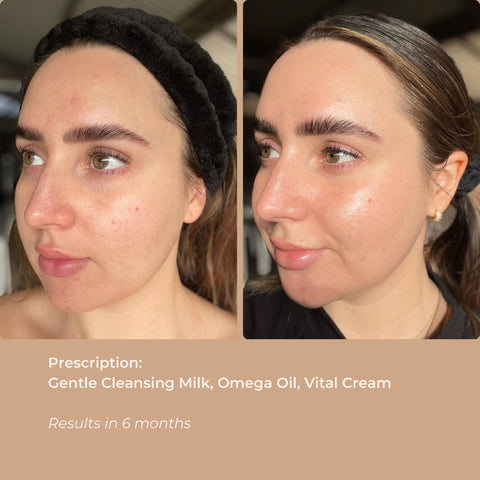 Before and after images showing skin improvement after using Gentle Cleansing Milk.